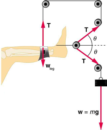 Diagrama de uma perna em tração.
