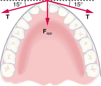 A seção transversal da mandíbula com dezesseis dentes é mostrada. O aparelho ortodôntico fica ao longo da parte externa dos dentes. Três forças estão atuando no dente saliente. A força aplicada, F sub app, é mostrada por uma seta verticalmente para baixo; uma segunda força, T, é mostrada por uma seta fazendo um ângulo de quinze graus abaixo do eixo x positivo; e uma terceira força, T, é mostrada por uma seta fazendo um ângulo de quinze graus abaixo do eixo x negativo.
