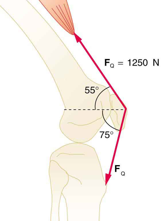 A figura mostra uma vista lateral dos ossos do joelho e do músculo quadríceps. O osso superior está inclinado a cinquenta e cinco graus em relação à horizontal e a tensão exercida pelo músculo quadríceps é de mil duzentos e cinquenta newtons. O tendão da rótula até o osso inferior está inclinado a setenta e cinco graus abaixo da horizontal. A força nessa direção é a mesma fornecida pelo quadríceps.