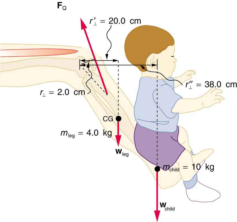 Uma perna de uma pessoa é mostrada. No pé, uma criança está sentada. O peso da criança é de dez quilos agindo para baixo. O centro de gravidade da perna é mostrado na parte central da perna. O joelho está atuando como um pivô. A massa da perna é marcada como quatro quilos. A distância da cabeça da criança é de trinta e oito centímetros do pivô e a distância perpendicular entre o centro de gravidade da perna e o pivô é de vinte centímetros.