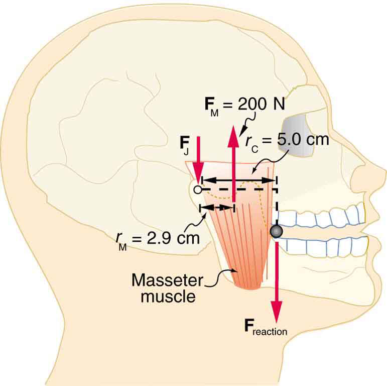 Os músculos masseter de uma mandíbula de um homem são mostrados. A força F sub M é igual a duzentos newtons e está atuando no músculo na direção ascendente e a força F sub J está atuando na extremidade esquerda do músculo para baixo. A extensão do músculo na parte superior é de cinco centímetros. Na articulação da mandíbula, a força de reação é descendente.