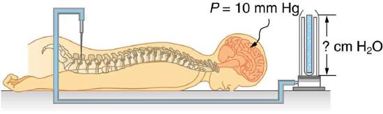 Diagram of a person lying face-down on a table hooked up to a medical apparatus. A needle attached to a tube is inserted between the patient's vertebrae in the lower back area. The tube, which appears to be filled with fluid, is connected to an upright tube containing an unknown amount of water. The height of the water in the tube is labeled question-mark centimeters H 2 O. A label pointing to the patient's head reads P equals ten millimeters H g.