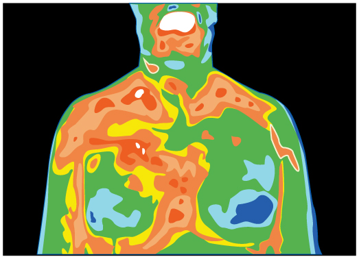 Um termógrafo da área do tórax de um paciente é mostrado. Existem cores diferentes que mostram diferentes regiões térmicas.