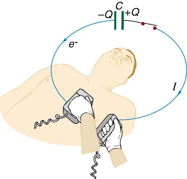 A figura representa uma unidade de desfibrilação usada em um paciente. O circuito também está representado. Mostra um capacitor dirigindo uma corrente pelo peito de um paciente. As placas opostas do capacitor são marcadas como Q positivo e Q negativo. A direção da corrente nos fios de conexão do capacitor à unidade de desfibrilação é mostrada no sentido horário com uma seta no fio, e a direção dos elétrons é mostrada oposta a essa direção com uma seta .
