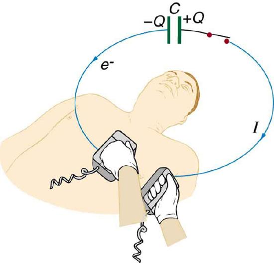 Figure represents a defibrillation unit used on a patient. The circuit is also represented. It shows a capacitor driving a current through the chest of a patient. The opposite plates of the capacitor are marked as positive Q and negative Q. The direction of current in the connecting wires from the capacitor to the defibrillation unit is shown in a clockwise direction with an arrow on the wire, and the direction of electrons is shown opposite to this direction with an arrow.