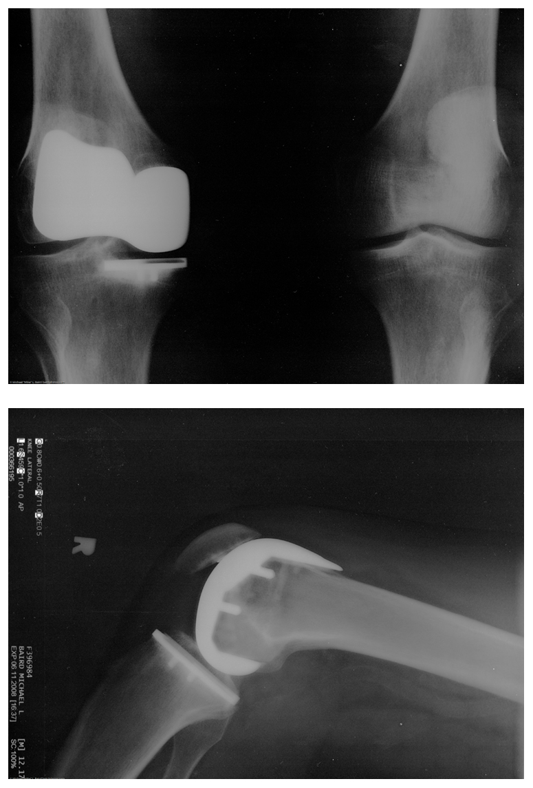 Dois raios X de uma prótese artificial de joelho são mostrados.
