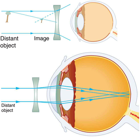 Duas ilustrações da visão transversal de um olho são mostradas. Na primeira figura, uma lente de óculos divergente é colocada na frente da estrutura do olho. Um diagrama de raios para a lente divergente também é mostrado. Raios paralelos de um objeto distante, tomados como árvore, atingem a lente e depois divergem. Uma imagem menor da árvore é mostrada na frente da lente. Na segunda figura, é mostrado um diagrama de raios em relação à lente divergente dentro da estrutura ocular. Raios paralelos de um objeto distante estão atingindo a lente divergente, entrando na lente do olho e convergindo para a retina. Isso explica a correção da miopia usando uma lente divergente.