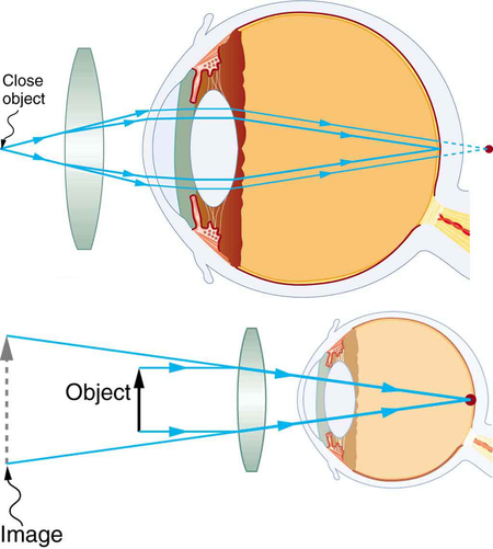 Duas ilustrações de uma visão transversal de um olho são mostradas. Na parte superior da figura, uma lente convergente é colocada na frente da estrutura do olho e um objeto próximo à sua frente. Um diagrama de raios mostrando que os raios do objeto estão atingindo a lente; convergindo um pouco e entrando nos olhos; convergindo novamente pela lente ocular e formando uma imagem na retina, e outro conjunto de raios converge para trás da retina. A parte inferior da figura mostra uma imagem virtual, um objeto, uma lente convergente e a estrutura interna de um olho. Raios paralelos do objeto estão entrando nos olhos e convergindo em um ponto da retina. Uma imagem maior do que a imagem do objeto é formada atrás do objeto no mesmo lado da lente.