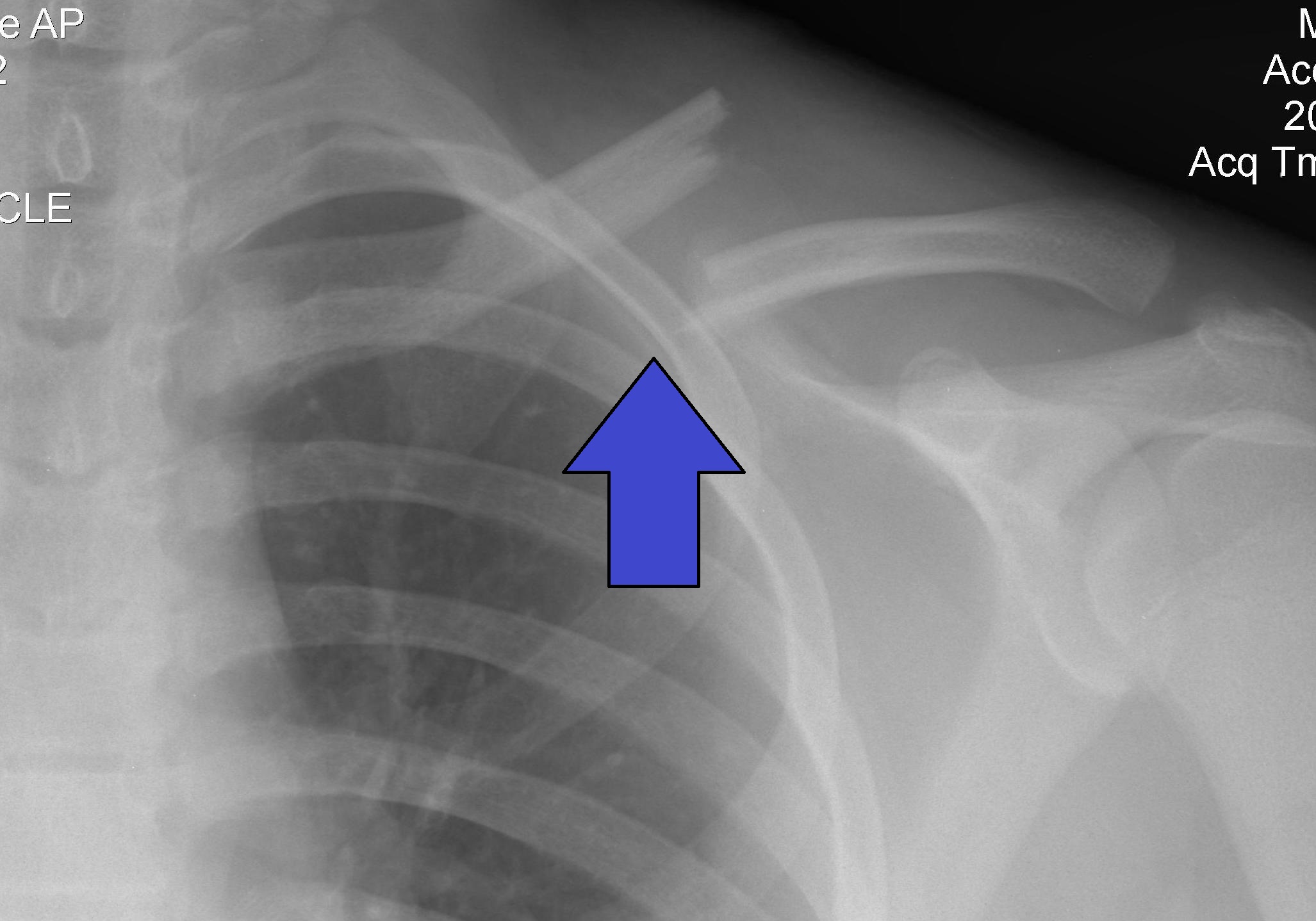 Clavicle_Fracture_Left.jpg