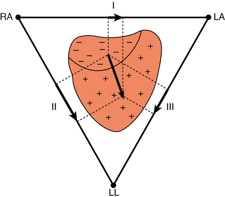 A figura mostra que a distribuição da carga na superfície externa do coração muda de positiva para negativa durante a despolarização. Essa onda de despolarização, que se espalha do canto superior direito em direção à parte inferior esquerda do coração, é representada por um vetor apontando na direção da onda. Os componentes desse vetor são medidos pela colocação de eletrodos no peito do paciente. A figura mostra três eletrodos, rotulados R A, L A e L L, colocados para formar um triângulo ao redor do coração. O eletrodo R A está próximo ao átrio direito, L A está próximo ao átrio esquerdo e L L está logo abaixo do coração. R A e L A formam um par chamado chumbo um, R A e L L formam um segundo par chamado liderança dois, e L A e L L formam um terceiro par chamado liderança três. Cada par de eletrodos mede um componente do vetor de despolarização.