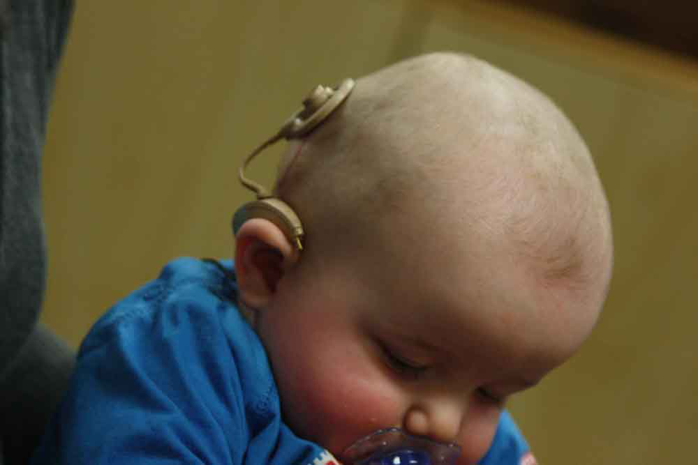 Fotografia de um bebê com um dispositivo acoplado na parte inferior da cabeça, logo acima da orelha direita.