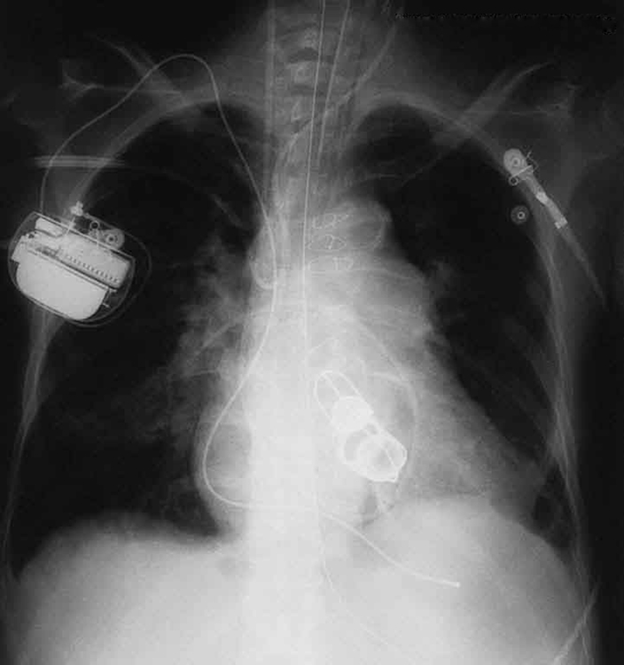 Uma imagem de raio-X do peito é mostrada. Mostra a seção do coração com válvulas cardíacas artificiais, um marca-passo e os fios usados para fechar o esterno.