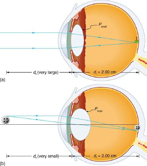 Two cross-sectional views of eye anatomy are shown. In part a of the figure, parallel rays from distant object are entering the eye and are converging on the retina to produce an inverted image of the tree shown above the principle axis. The interior lens of the eye is relaxed and least rounded, given as P small. Distance of image d i is equal to two centimeters, which is the measure of the distance from lens to retina. Distance of object d o is given as very large. In part b of the figure, rays from a button, which is a nearby object, are shown to diverge as they enter the eye. The interior lens of the eye, P large, converges the rays to form an image at retina, below the principle axis. Distance of image d i is equal to two centimeters, which is the measure of distance from lens to retina. Distance of object d o is given as very small.