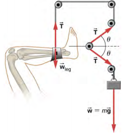 该图显示左边有一条腿。 它固定在脚踝处的绳子上，悬挂在顶部的滑轮上。 绳索延伸到第一个滑轮右侧的第二个滑轮，第三个滑轮延伸到第二个滑轮的底部，第四个滑轮延伸到第三个滑轮的左下角，第五个滑轮延伸到第四个滑轮的右下角。 绳索末端附着一个重量为 w = mg 的物体。 标有 w 下标腿的箭头指向脚踝向下方，标有 T 的箭头从脚踝指向上方。 标有 T 的箭头，从第四个滑轮到第三个滑轮，与水平方向形成一个角度 theta。 另一个标有 T 的箭头，从第四个滑轮到第五个滑轮与水平方向形成一个减去 theta 的角度。