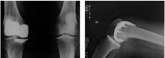 Duas fotos de raio-X de próteses artificiais de joelho.