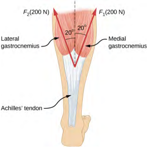 An Achilles tendon is shown in the figure with two forces exerted on it by the lateral and medial heads of the gastrocnemius muscle. F sub one, equal to two hundred Newtons, is shown as a vector making an angle twenty degrees to the right of vertical, and F sub two, equal to two hundred Newtons, is shown making an angle of twenty degrees left of vertical.