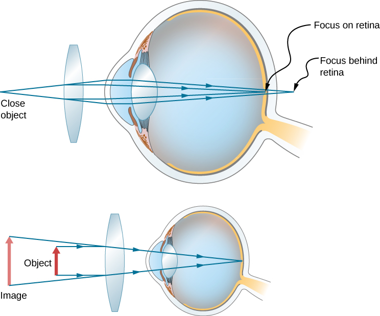 A figura mostra dois olhos com uma lente biconvexa na frente de cada um. O primeiro mostra raios de um objeto próximo atingindo a lente e se desviando um em direção ao outro antes de atingir a córnea. Eles então convergem para a retina. A segunda mostra um objeto próximo à lente e uma imagem maior e vertical mais distante da lente.