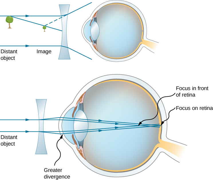Figure shows two eyes with a bi-concave lens in front of each. The first one shows a tree as a distant object, and the image of the tree closer to the lens. The second one shows parallel rays from the distant object striking the lens and diverging before they strike the cornea. They then converge on the retina.