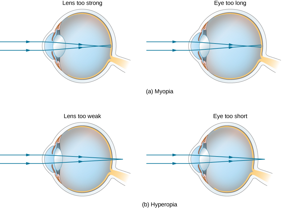 图 a 显示了标有 “镜头太强” 和 “眼睛太长” 的两只眼睛。 在这两种情况下，照射角膜的平行光线都会聚集在视网膜前面。 图 b 显示了标有 “镜头太弱” 和 “眼睛太短” 的两只眼睛。 在这两种情况下，照射角膜的平行光线都会聚集在视网膜后面。