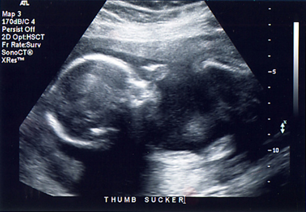 Imagem ultrassonográfica de um feto de 21 semanas.