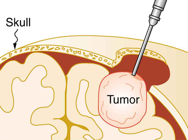 Uma imagem de um tumor cerebral sendo removido do crânio usando uma sonda clínica.