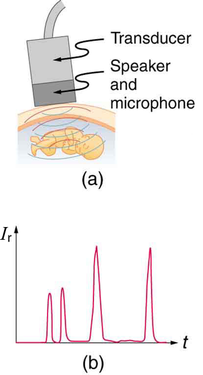 A primeira parte do diagrama mostra um transdutor retangular com alto-falante e microfone enviando ondas esféricas para produzir ecos de um feto. A segunda parte mostra um gráfico da intensidade do eco versus tempo, com quatro picos nítidos.