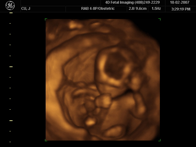 Esta é uma imagem de uma ultrassonografia 3D do feto mostrando um feto chupando o polegar.