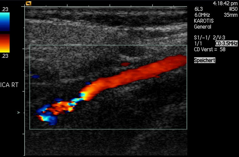 Imagem ultrassônica com desvio de Doppler de uma artéria parcialmente ocluída.