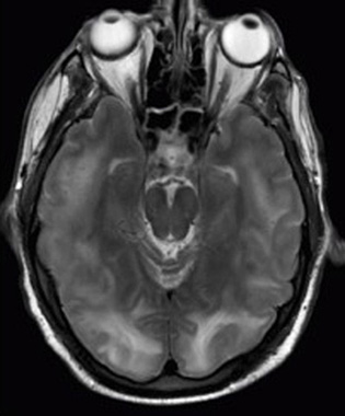 M R I scan de um cérebro com tumores específicos.
