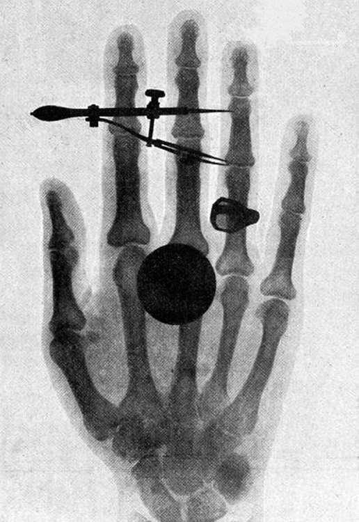 Uma imagem de raio-x da mão de Bertha Röentgen é mostrada com uma mancha circular escura sobreposta nos dedos.