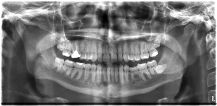 A imagem de raio-X da vista frontal da mandíbula, especialmente dos dentes.