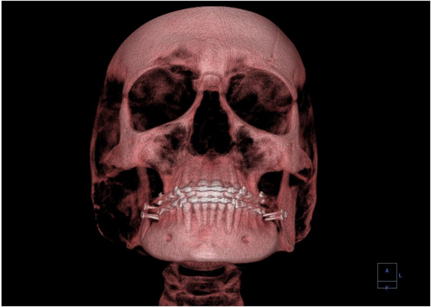 Uma imagem 3D mostrando um crânio humano de frente.