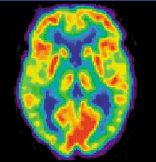 A brain scan. Different regions of the brain are shown in different colors.