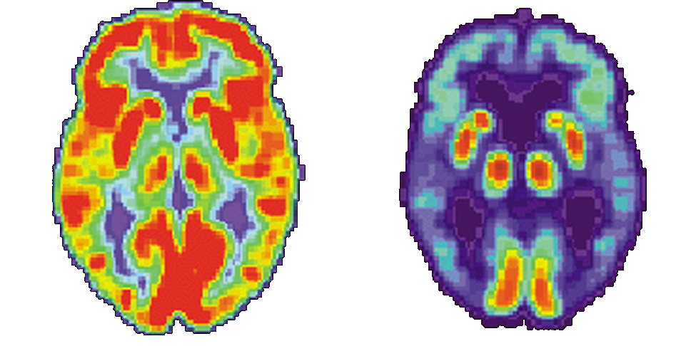 Two images of brains are shown. The one on the left has many red and orange areas and some blue areas. The one on the right is mostly blue with very small areas in red and yellow.